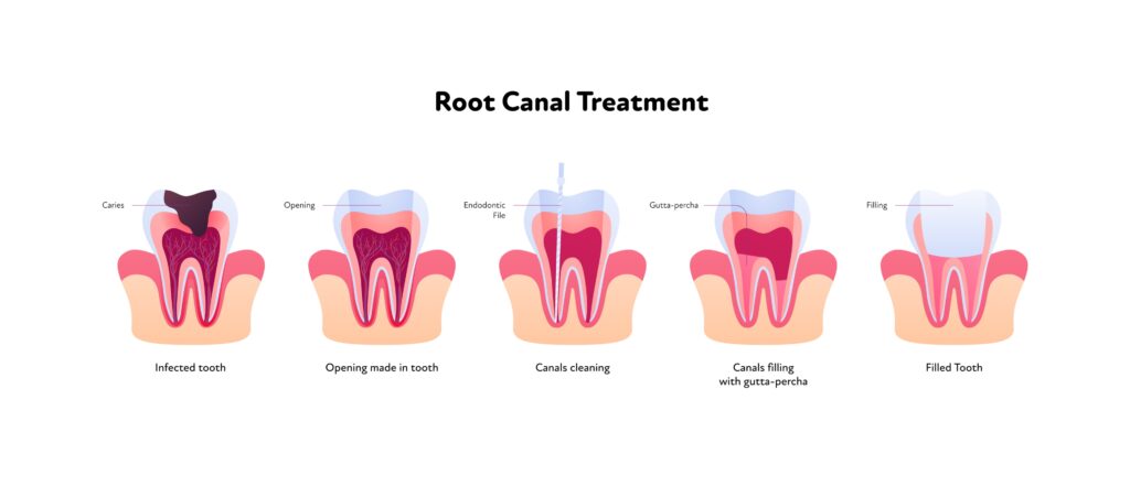 Root Canal Procedure